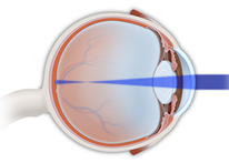 Ophthalmology | Astigmatism Treatment | Chalfont