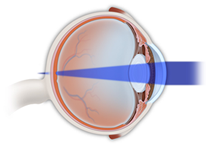 Ophthalmology | Astigmatism Treatment | Chalfont