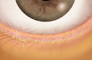 Blepharitis Treatment | Chalfont