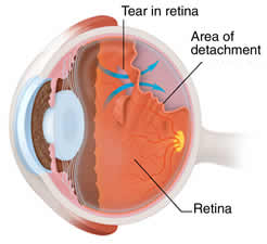 Diabetic Eye Treatment | Chalfont