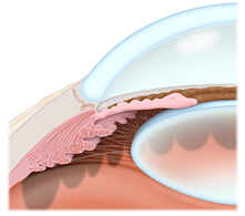 Glaucoma Treatment | Chalfont