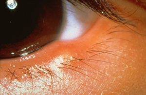 Blepharitis Treatment | Chalfont