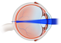 Ophthalmology | Astigmatism Treatment | Chalfont